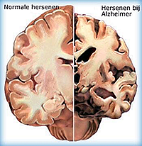 hersenen gezond en alzheimer